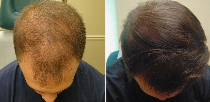 Before &After